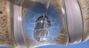 Kyphoplasty Surgery image