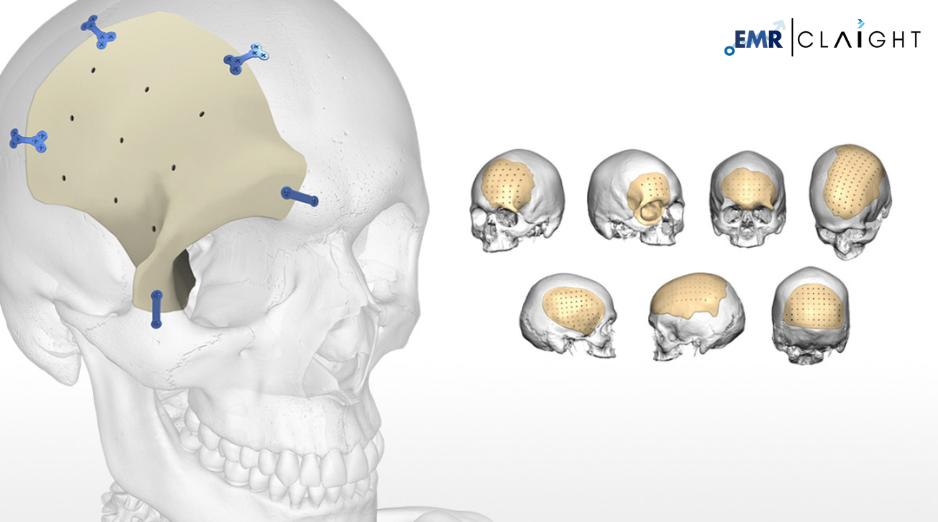 Global Cranial Implants Market