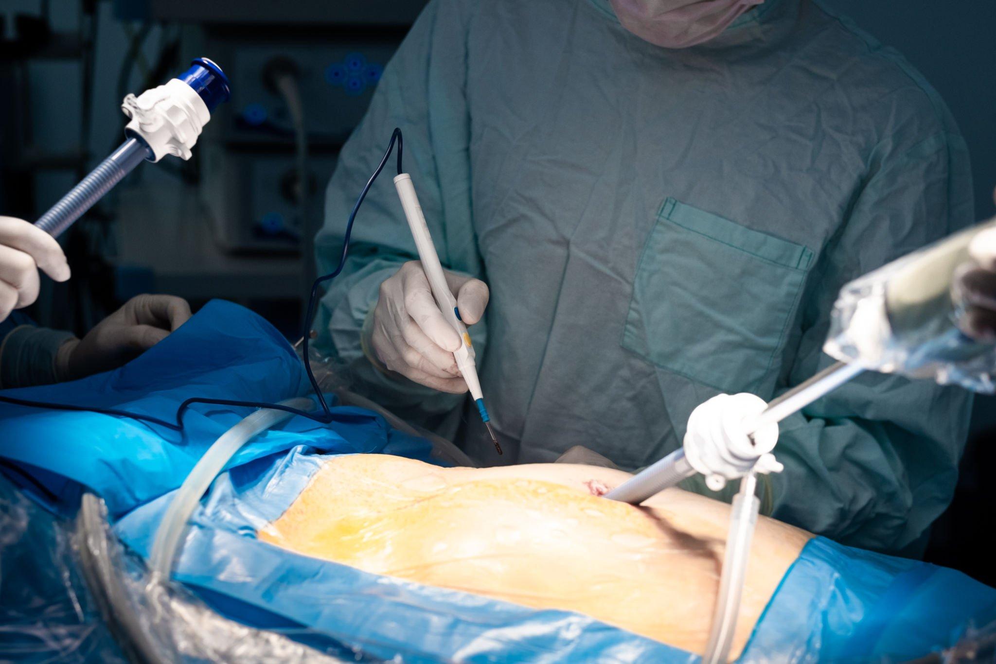 Laparoscopic Hernia Surgery in Guwahati