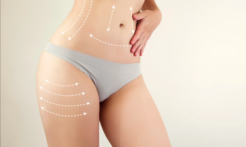 Liposuction in Dubai