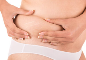 Best Stretch Marks Treatment Doctor In Guwahati