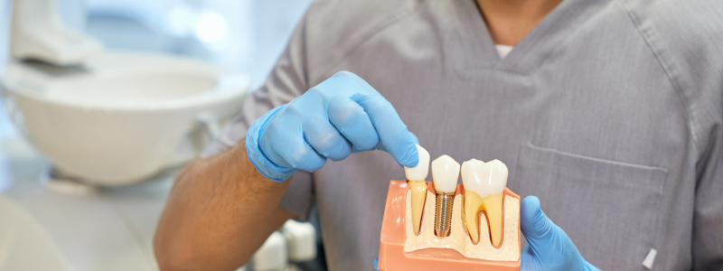 Why Choose Dental Implants