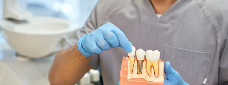 Why Choose Dental Implants?