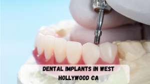 dental implants in West Hollywood, CA