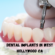 dental implants in West Hollywood, CA