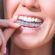 best invisalign london