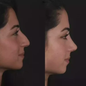 Who Can Benefit from Nose Surgery in Dubai?