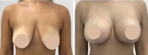 breast lift in dubai