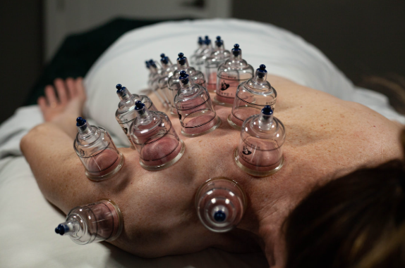 Massage cupping Pleasant Grove