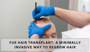 FUE hair transplant in Los Angeles