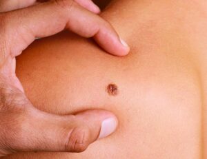 what does skin cancer look like