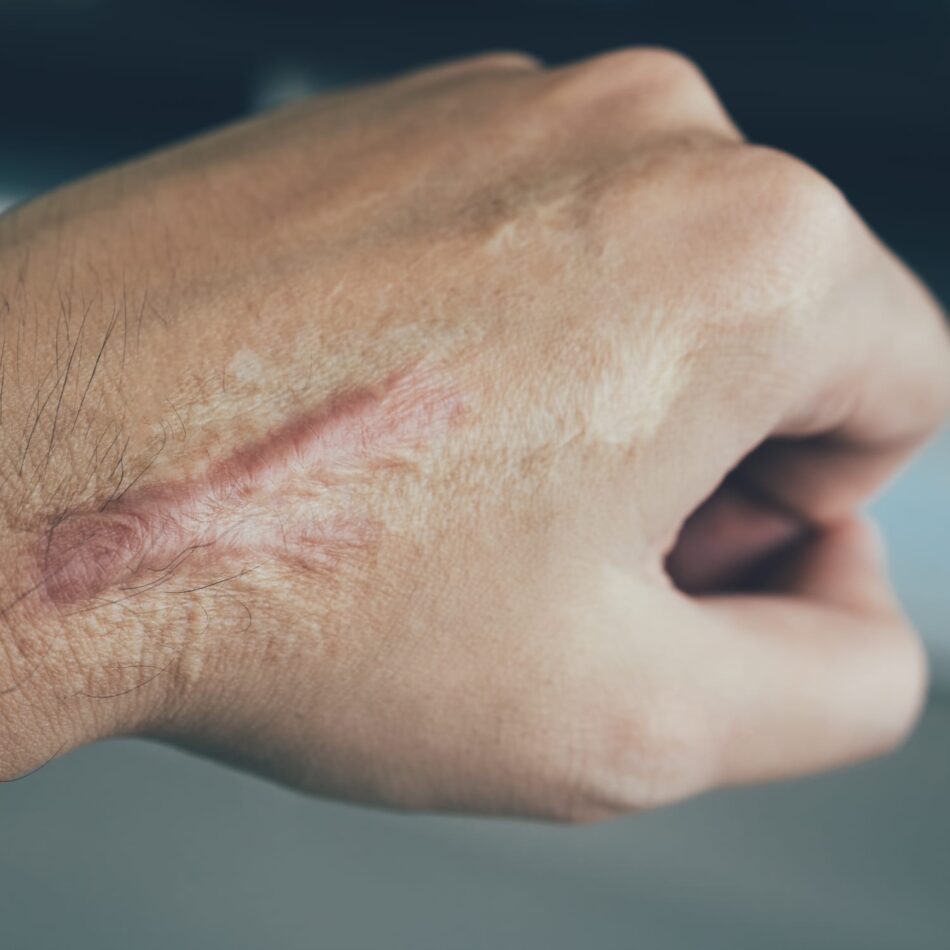 Can Laser Scar Removal Help With Acne Scars?