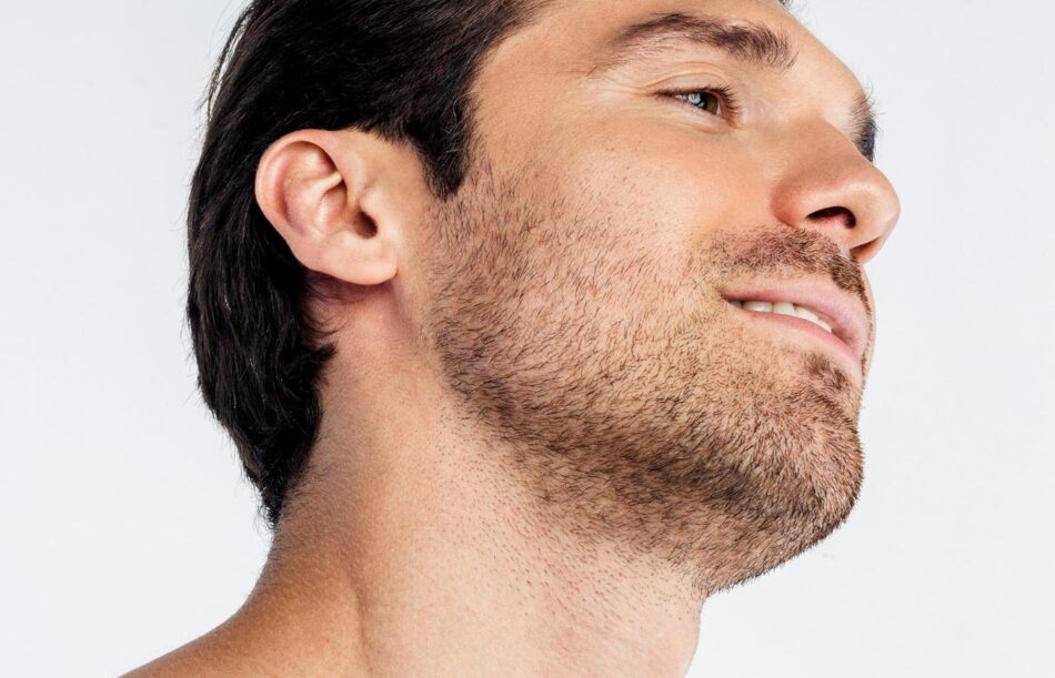 How FUE Hair Transplant Helps with Patchy Beards