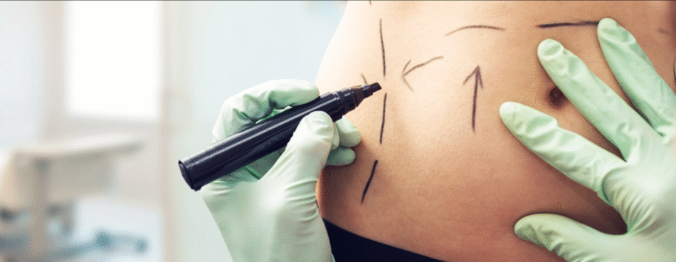 Liposuction in Dubai