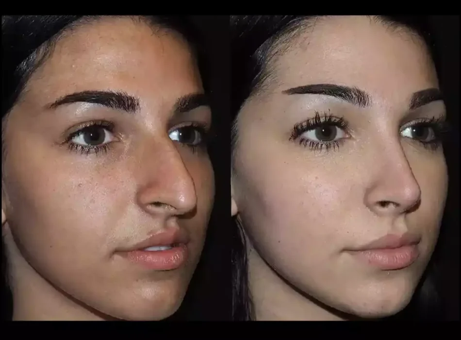 Nose Surgery in Dubai: A Guide for International Patients