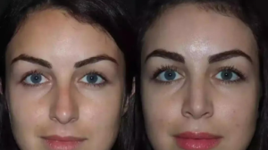 Benefits of Choosing Rhinoplasty in Dubai for Nose Reshaping