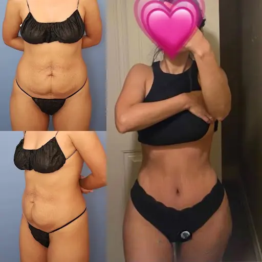 Tummy Tuck in Dubai