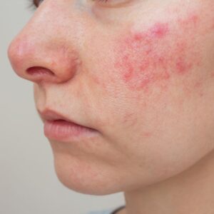 Rosacea Treatment In Dubai