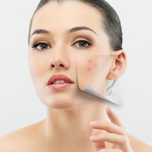 Acne Scars removal in Islamabad