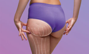 Everything You Need to Know About Butt Fat Transfer in Dubai: A Complete Guide