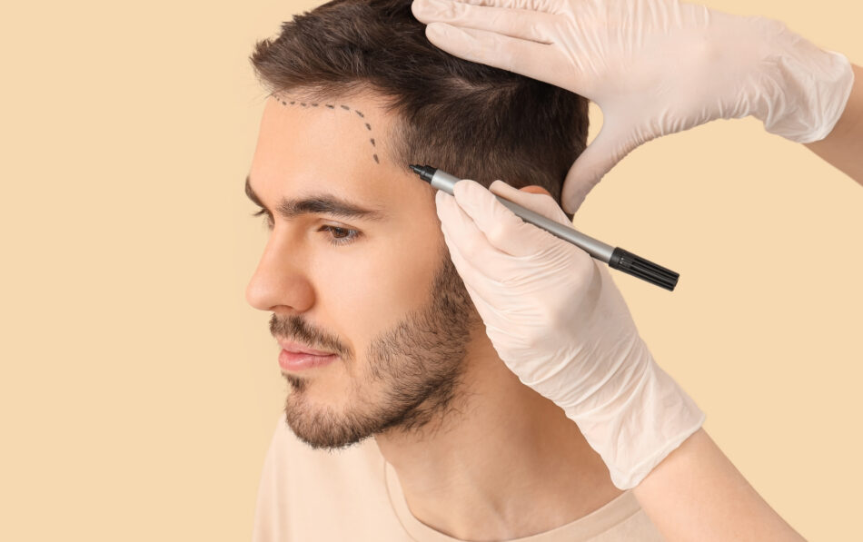 Breaking Down the procedure Is a Hair Transplant Worth