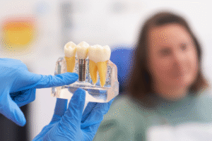 Dental Implants in Islamabad