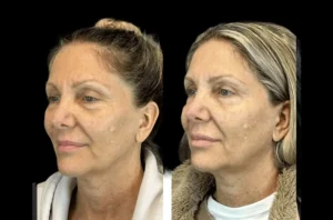 Botox in dubai
