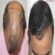 Hair transplant in Dubai