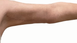 How Arm Lift Surgery Can Transform Your Upper Body