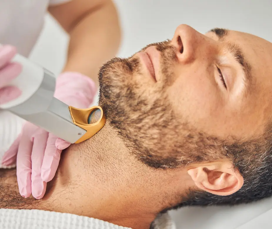 How Beard Laser Hair Removal Works