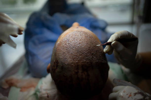 Hair Transplant Abu Dhabi