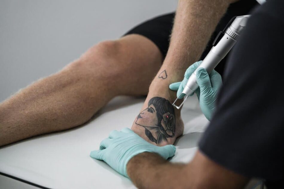 Laser Tattoo Removal for All Skin Types