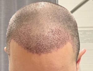 Premium Hair Transplants at Reasonable Prices