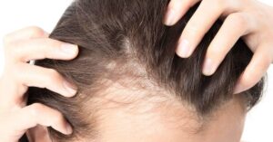 Revolutionary Hair Loss Treatments Now