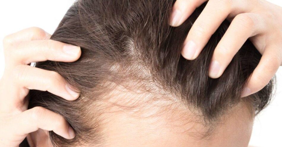 Revolutionary Hair Loss Treatments Now