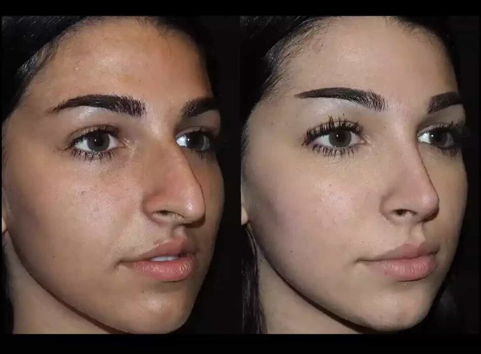 septoplasty in dubai
