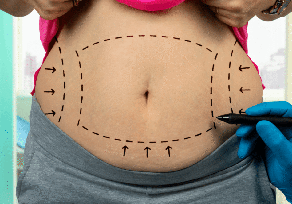The Benefits of Choosing GPS Laser Liposuction