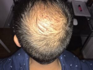 The Incredible Impact of Crown Hair Transplant