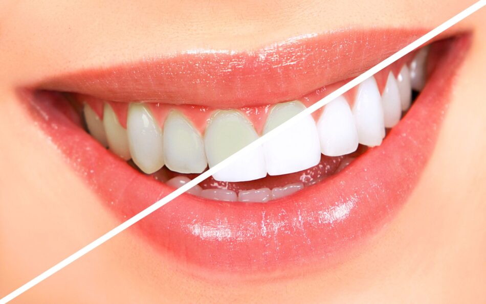 What Causes Teeth Stains and Can Whitening Remove Them All