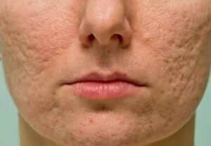 What Is the Safest Acne Scar Treatment?