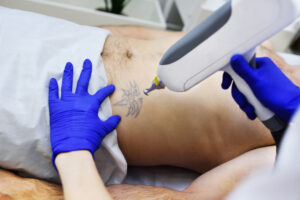 Why Choose Laser Tattoo Removal