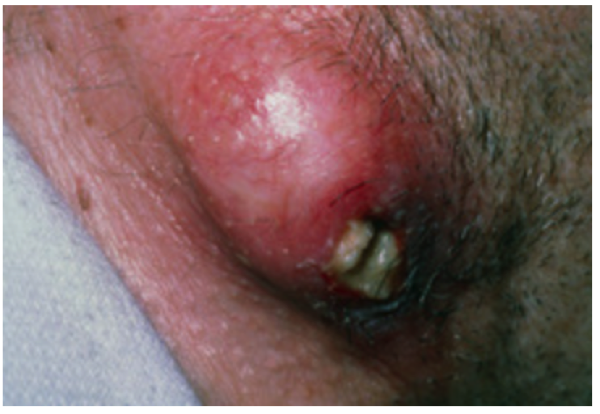 Infected Sebaceous Cyst Home Treatment: Do’s and Don’ts You Must Know