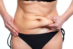 Tummy Tuck in Dubai