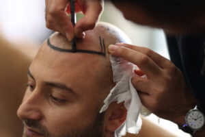 كيف تستعد لزراعة الشعر؟
