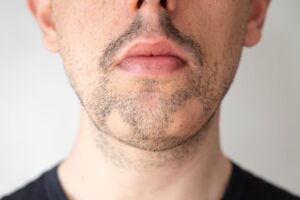 Can Transplants Help Patchy Beards?
