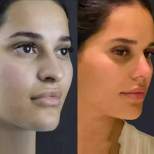 rhinoplasty in dubai