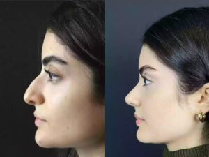 rhinoplasty in dubai