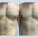 How Cultural Perceptions Influence Treatment of Gynecomastia in Dubai
