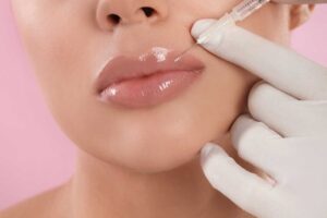 How Long Do Lip Fillers Last