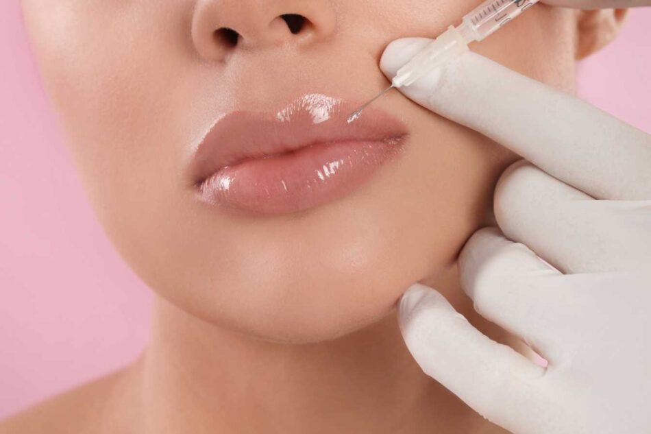 How Long Do Lip Fillers Last